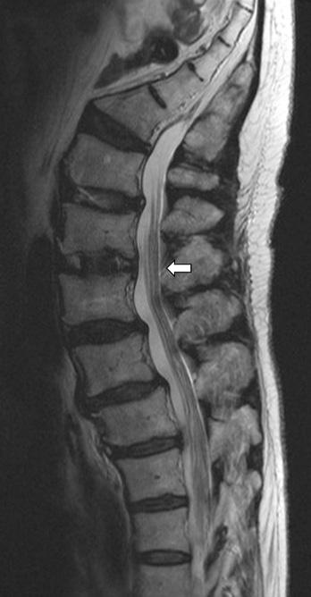 kyphosis on lumbar spine had been corrected. LL, lumbar lordosis; SS, sacral slope; PT, pelvic tilt.