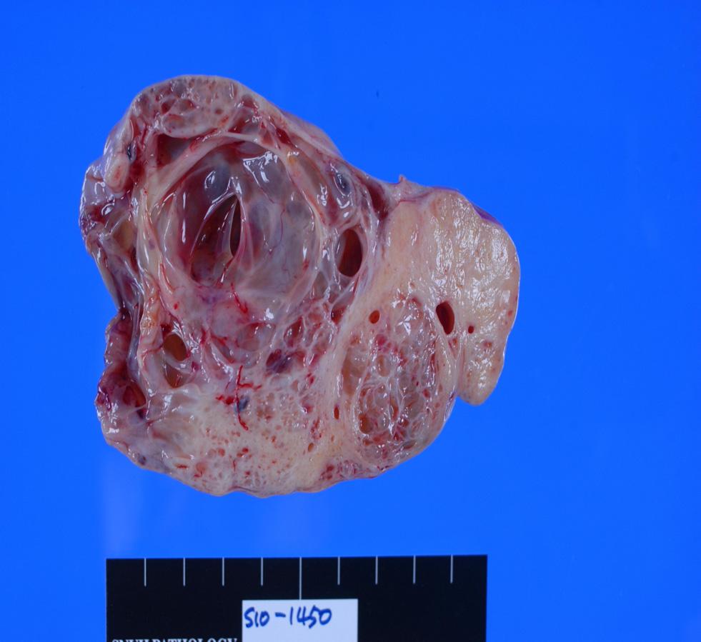 김수아 외 5인. 경계성 투명세포섬유선종 1예 A B Fig. 2. (A) The cut surface of ovarian cystic mass was solid and variable sized cysts in appearance and had minute cysts embedded in a firm stroma.