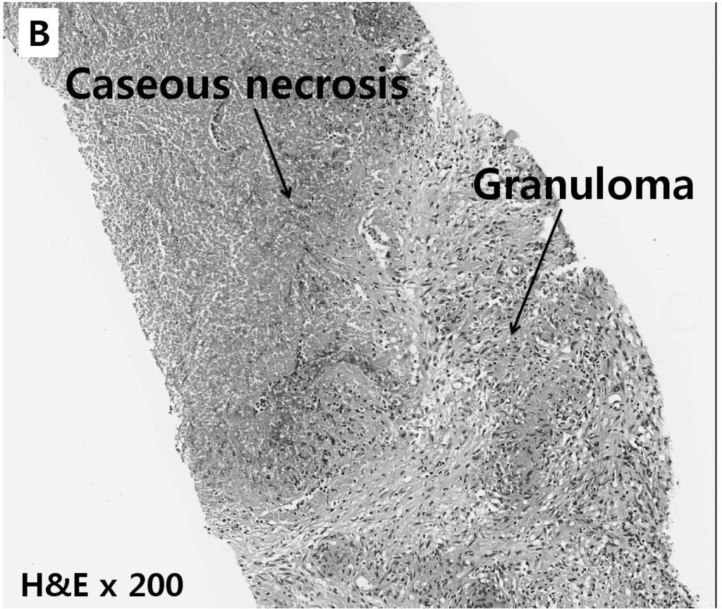 (B) The high power view of the granuloma with necrosis.