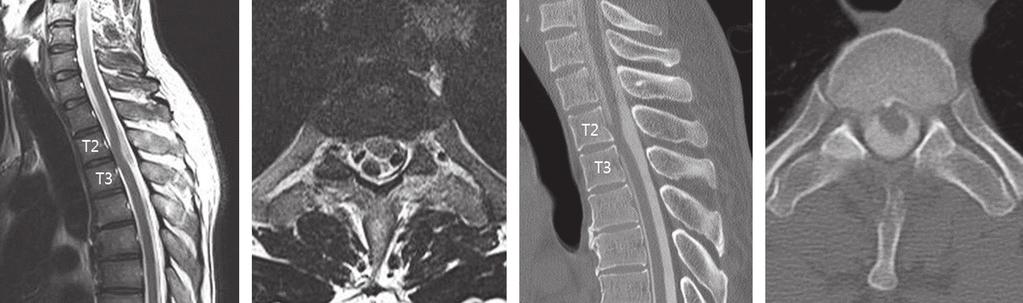 Journal of Korean Society of Spine Surgery A B C D Fig. 2. Idiopathic spinal cord herniation in a 43-year-old man. He had a tingling sensation in his left leg for 3 years.