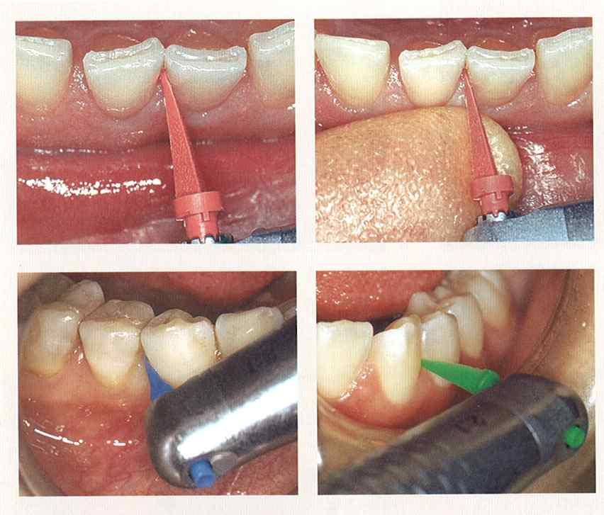 Contents 치면세균막 (dental plaque, oral