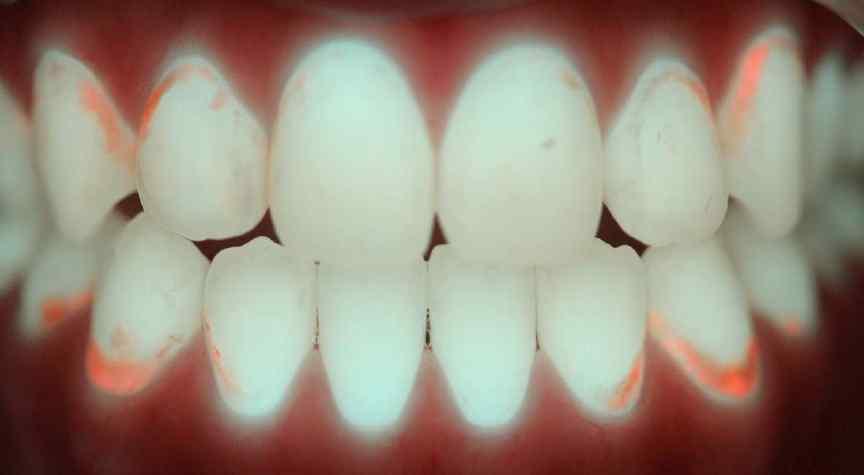 Self care mechanical tooth