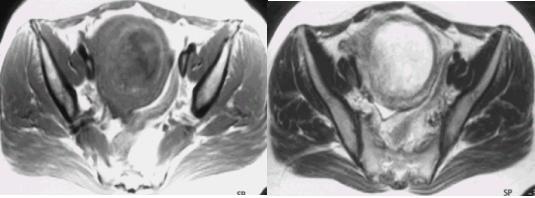 - 유지연외 14인 : 하시모토갑상선염환자에서포상기태에의해발생된 T 3-갑상선중독증 1예- Fig. 1. Pelvis MRI shows uterus enlargement (11 8 12 cm) and tiny cystic mass was filled in uterine cavity.
