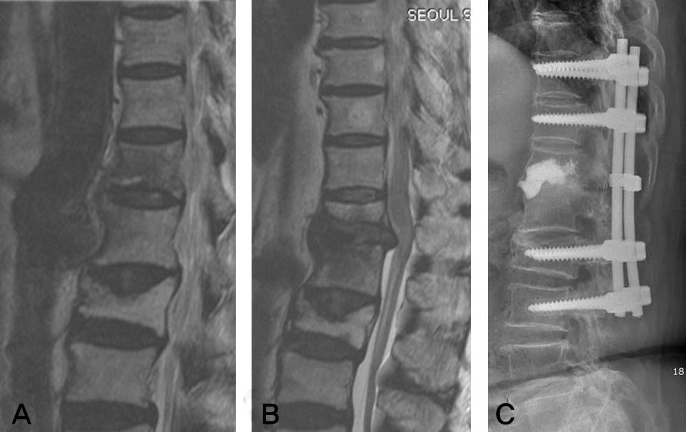 Journal of Korean Society of Spine Surgery Tardy Spinal Cord Compression after Kyphoplasty 증례보고 증례 1. 65세여자로골밀도는 T-점수 -3.08이었으며체질량지수 (BMI: Body mass index) 는 33이었다.