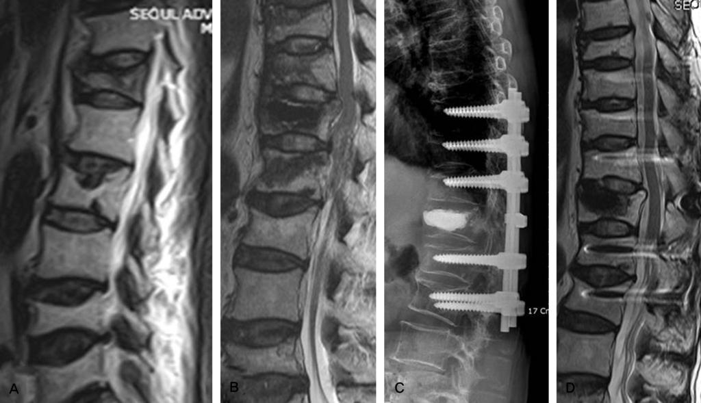 Dong Ki Ahn et al Volume 17 Number 2 June 2010 Fig. 2. (A) T12 compression fracture resulted in severely collapsed deformity.