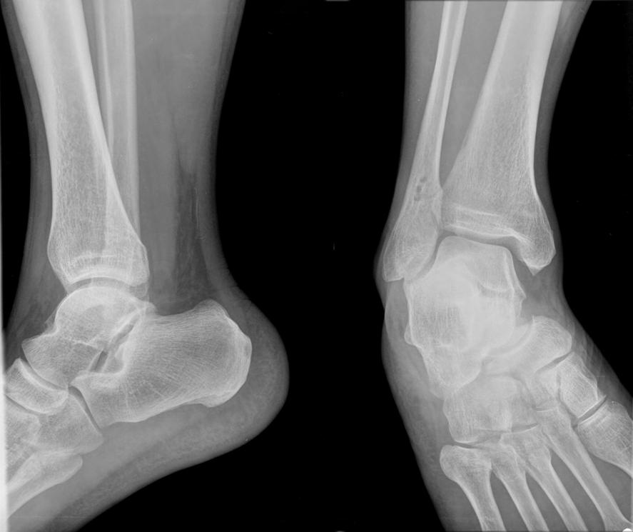 Spiral Danis-Weber type B fracture of lateral malleolus in a 56-year-old woman. (A) Preoperative anteroposterior and lateral views.