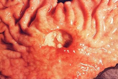 ULCERS Local defect of the surface of an organ or tissue that is