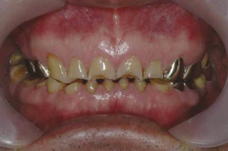 치아수복재료의선택은교합면의교모를최소화하고부여한수직교합고경과적절한교합접촉을유지할수있도록이루어져야한다.