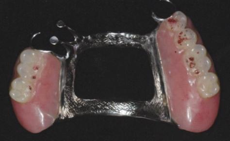 A B C D Fig. 5. Intraoral photographs after the placement of definitive prostheses.