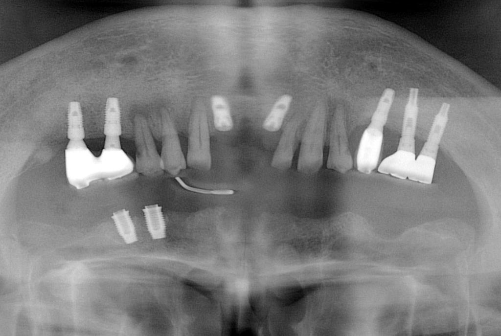 Matured peri-implant soft tissue structure after 2nd surgery. Fig. 3.