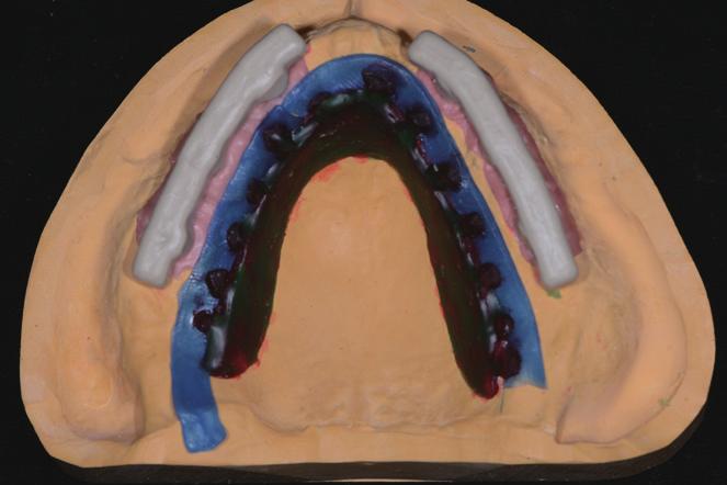 prosthesis, (E) Delivery of overdenture, front