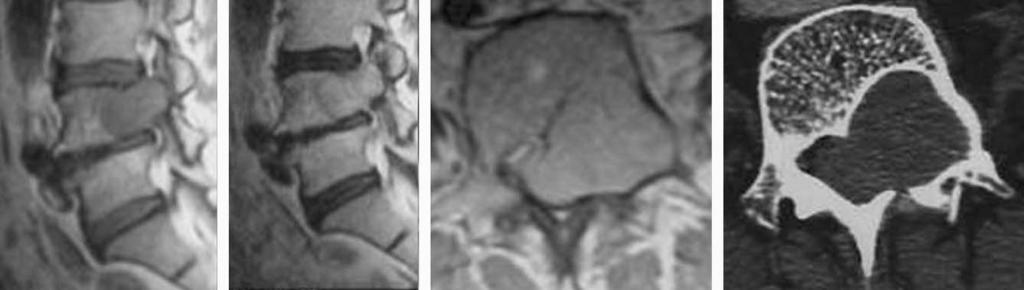 Sagittal T1 (A) and T2 (B) image show neurilemmoma involving vertebral body pedicle.