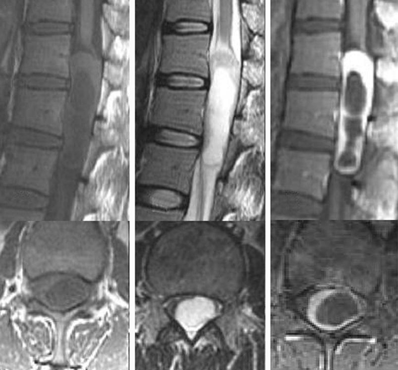 대한척추외과학회지 Vol. 16, No. 1, 2009 Fig. 3. Neurilemmoma with cystic changes. Sagittal and axial T1 (A),T2 (B), and postcontrast (C) image show a cystic intradural neurilemmoma at thoracic spine.