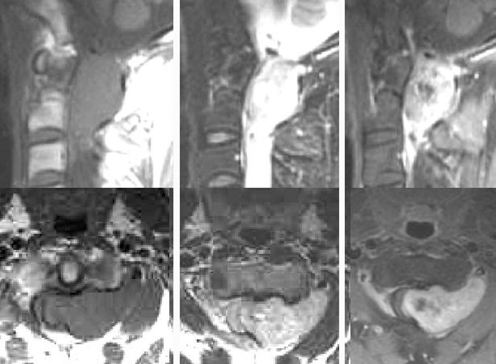 신경막종양에서나타나는다양한자기공명영상소견 정재윤외 Fig. 4. Neurilemmoma with focal hemorrhage. Sagittal and axial T1 (A), T2 (B) image show a dumbbell shape neurilemmoma.with extraforaminal soft tissue extension.