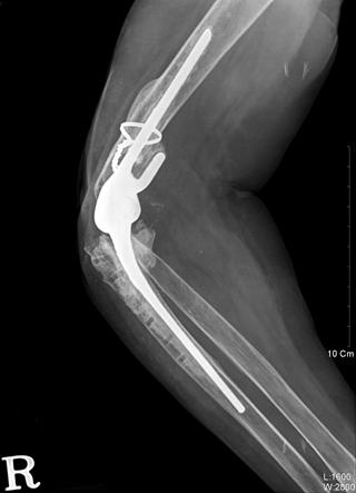 468 이진웅ㆍ고재근ㆍ조남수외 1 인 ig. 2. A 66-year-old woman. (A) Radiographs of the elbow before the revision surgery. The radiographs show aseptic loosening.