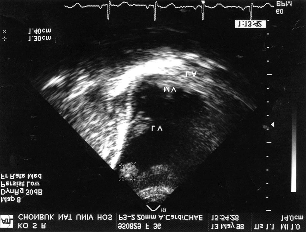 Follow-up echocardiogram revealed a thrombus in the left ventricualr lumen at the 3rd hospital day.