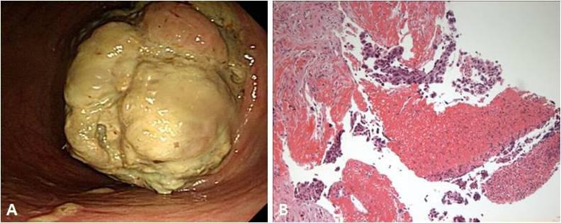 Figure 2. (A) At sigmoidoscopy, a huge fungating mass is seen 30-35 cm from the anal verge. (B) A biopsy reveals ulcer-related mucosa with atypical cells (H&E, 200). 양으로진단된예를경험하여문헌고찰과함께보고하고자한다.