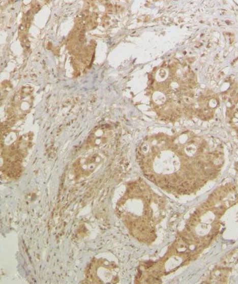 (D, E) VEGFR-2 expression in liver metastases along