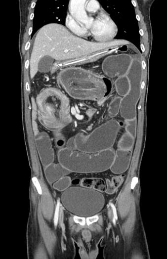 294 대한소화기내시경학회지 2008;37:293-298 Figure 1. Abdominal CT findings. (A) It shows a target-like lesion in the right abdomen which is intussuscepting into the ascending colon. Also, about a 3.