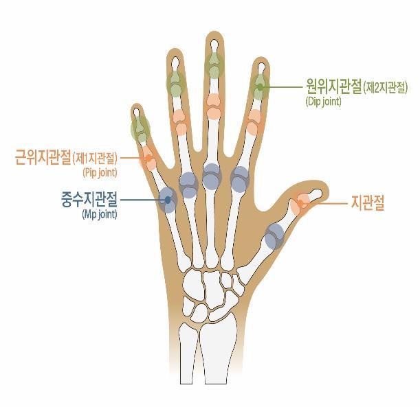 4) 다른네손가락에는 3 개의손가락관절이있다. 그중심장에서가까운쪽부터중수지관절, 제 1 지관절 ( 근위지관절 ) 및제 2 지관절 ( 원위지관절 ) 이라부른다. 5) 손가락을잃었을때 라함은첫째손가락에서는지관절부터심장에서가까운쪽에서, 다른네손가락에서는제 1 지관절 ( 근위지관절 ) 부터 ( 제 1 지관절포함 ) 심장에서가까운쪽으로손가락이절단되었을때를말한다.