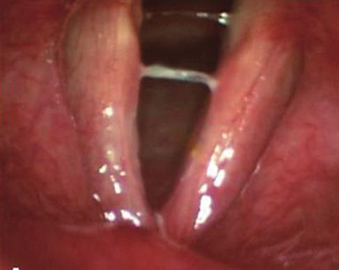 Acellular Dermal Graft Implantation Laryngoplasty Ahn CM, et al.