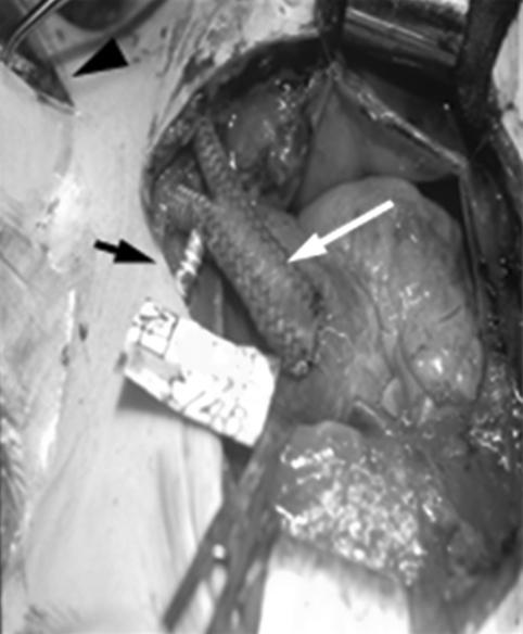 108 대한혈관외과학회지 : 제 24 권제 2 호 2008 Fig. 2. The photos shows the patient of Takayasu s arteritis be operated due to both subclavian arteries and Lt. common carotid artery lesions.