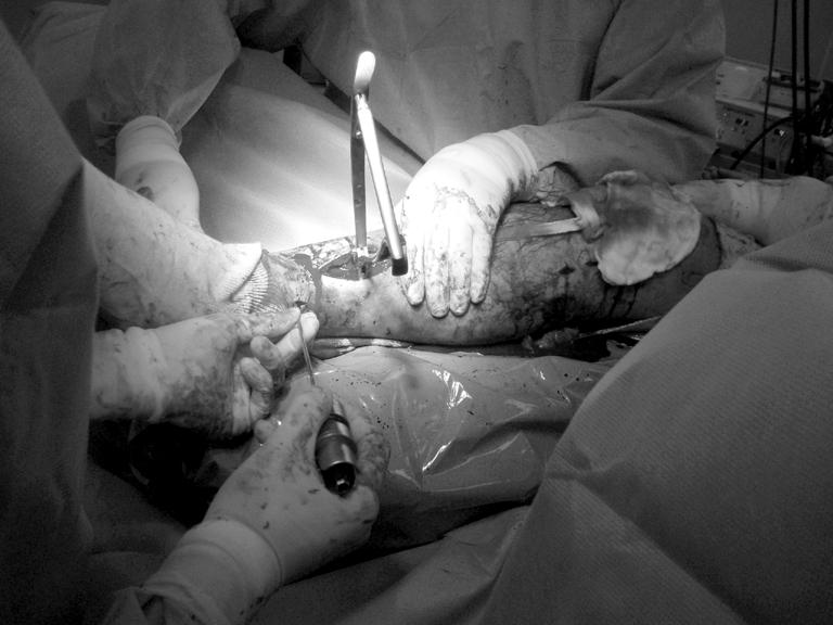 4). 골절부위 피부절개를 통하여 골편을 골 겸자(bone clamp) 를 이용한 관혈적 해부학적 정복을 시행하였으며 직경 10 mm, 길이 320 mm의 금속정을 이용하여 골수 내 금속정 Fig. 6.