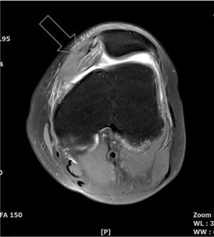 유경곤ㆍ김진희ㆍ민선정ㆍ염승룡ㆍ권영달ㆍ이지현 4. 진단 Lt. recurrent patellar dislocation 5. 현병력키는 165 cm 가량되며마른체격으로현재판매원으로장시간서서근무함. 중학교 2학년때부터 Lt. knee pain & mild swelling, Lt.