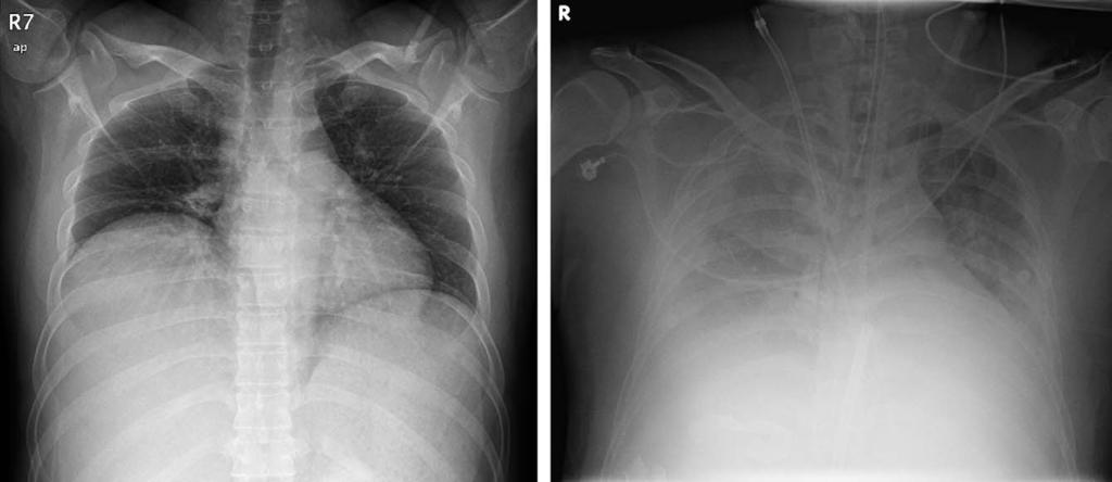 - Journal of Trauma and Injury Vol. 28, No. 1 - A B Fig. 1. Chest radiograph of a TRALI patient, preoperative state (A), showing the bilateral infiltrates respiratory distress syndrome) 에합당한양측폐의침범이확인되었다 (Fig.