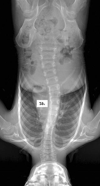 (B) Magnetic resonance imaging scan of the spine revealed syringomyelia (big arrow) with Chiari malformation