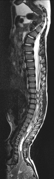 (C) After surgery, signs of syringomyelia has improved and the deformity angle remains stable with the
