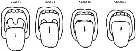 오세리 이진한 : 어려운기관내삽관이예상되는환자의기도관리 191 Class I Class II Class III Class IV Fig. 1. The Samsoon-Young modification of the Mallampati airway classification.