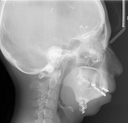 (A-D) Patient with Treacher Collins syndrome. (E-H) Patient with mandible hypoplasia due to childhood trauma.