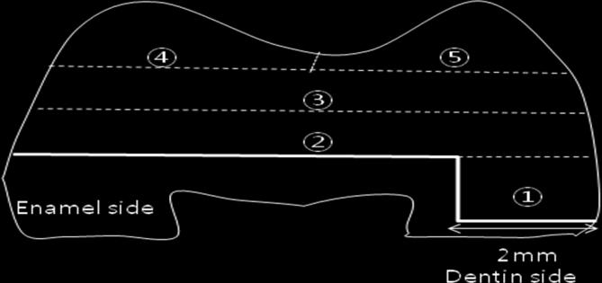 5 mm 이며인접면의한쪽은법랑질에, 다른한쪽은상아법랑경계부 1 mm 하방상아질에위치하도록했다. Fig. 4.