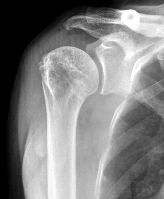 (C) Twelve months after surgery, radiograph shows that complete bone union was