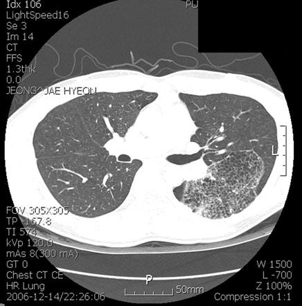 YJ Park et al: Congenital cystic adenomatoid malformation of lung Figure 1.