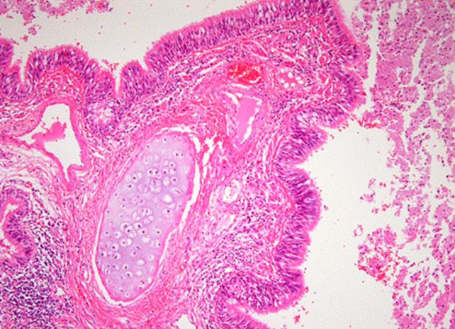 Gross finding of a resected right lower lobe in Case 6 shows one large cystic lesion and small variable sized cysts surrounding by bronchial like structures, accompanied with grayish pneumonic