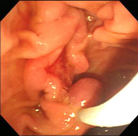 Endoscopic findings.