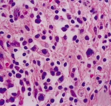 이식후림프증식성질환 47 A B Fig. 2. Case 1. (A) The lesion consists of lymphocytes, plasma cells, and scattered immunoblasts. (B) The nuclei of some lymphocytes are positive for EBV in situ hybridization.