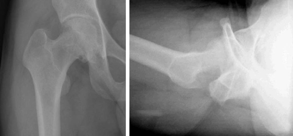Fig. 3. Images demonstrated uneven mild increased uptake diffuse increased uptake in right hip joint.
