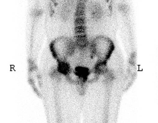 수술후 1 개월추시에서내회전및외전등관절운동범위가호전되었으며 6, 12 개월추시에서는관절운동제한은 Fig. 1. (, ) nteroposterior & axial Hip radiograph shows soft tissue density and bony erosion of the right femoral head.