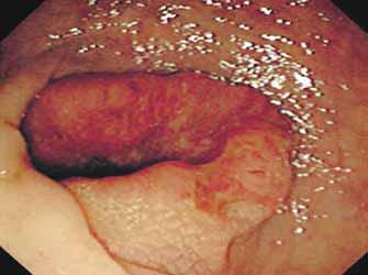 (B) Borrmann type 2 colorectal cancer shows an ulcerofungating mass whose edge is clearly demarcated from normal mucosa.