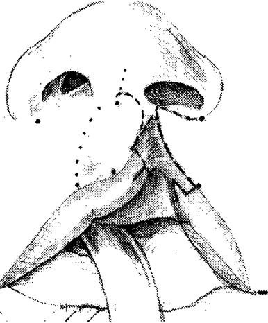 136 정영수 : 편측구순열비의 Mulliken 방법교정술 Fig. 3. Markings for rotation-advancement repair. Rotation incision bows and extends in columellar base.