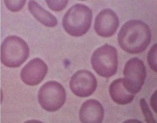 stain, 360). (B) The magnifi cation view of the peripheral blood smear showed target cells (arrow) (Wright stain, 1,000). 주소및현병력 : 임신부는첫아이임신 34주에교정되지않는혈색소 7.