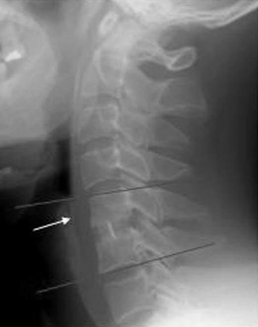 A Overall cervical lordosis B Segmental lordosis 35 3 5 15 5 3.75 9.79 3.7.59.7 19.33 17. 17.9 Pre op. 3 mon mon 1 mon 1 1 11.7 9...7.3 3.93 3.1. Pre op. 3 mon mon 1 mon (p=.) (p=.9) (p=.1) (p=.