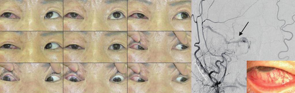 Choi J-H Headache and Eye Pain 듯한양상의매우심한통증을호소한다. 통증은눈에국한되기도하나부비동, 턱, 이마부위, 관자로전해지기도한다. 눈부심과압통, 시력저하등이동반될수있다. 특히뒤쪽공막염에서는안저소견상망막박리, 황반부종, 시신경부종등이관찰될수있다. 눈의가운데층인포도막의급성염증에서는눈부심과안통이발생한다.