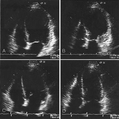 Left anterior oblique view, Left ventriculogram revealed akinesia of septal wall and posterolateral wall (diastole C and systole D). Figure 4. Echocardiography.