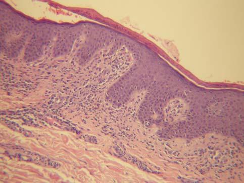 - 대한내과학회지 : 제 76 권제 2 호통권제 582 호 2009 - Figure 4. Skin biopsy showing marked inflammation in the papillary dermis and some atrophic changes with basal disruption of the epidermis (H&E stain, 100). 다.