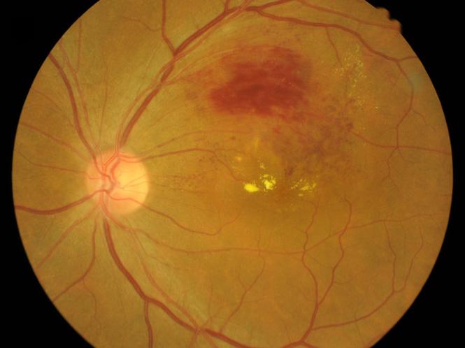 (C) Advanced glaucomatous cupping in open angle glaucoma.