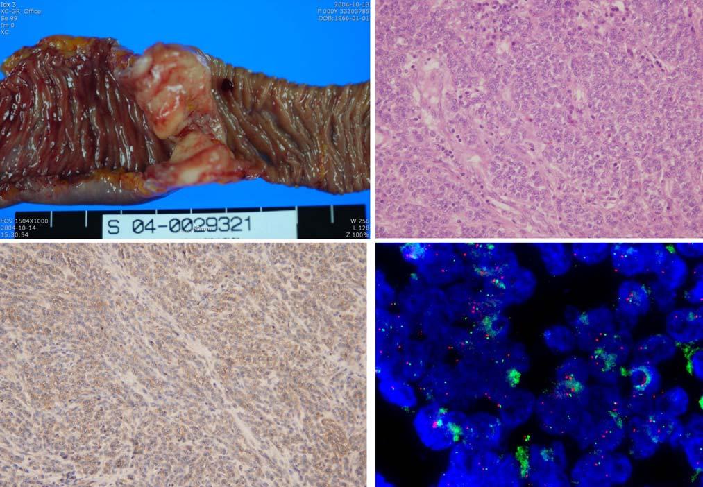 - Ki Hwan Kim, et al: Primitive neuroectodermal tumour of the jejunum : A Case Repo - A B C D Figure 2. (A) Gross appearance of the fungating mass encircling the jejunum.
